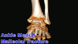 Ankle Medial Malleolar fracture [upl. by Adnoluy172]