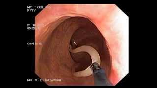 Ascaridosis on colonoscopy Аскариды при колоноскопии [upl. by Ennaimaj]