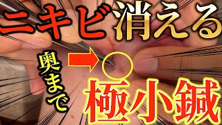 【肌荒れ ニキビ 鍼】最悪10年治らないニキビと肌荒れ 原因は〇〇。ニキビとその原因を治す自宅でできる方法も紹介します【東京銀座 横浜元町 美容鍼 ブレア】 [upl. by Abram]