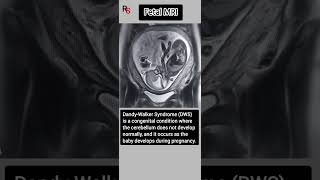 DandyWalker Syndrome ll DWS radiology mri brain shorts [upl. by Annenn]