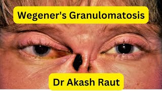 Wegeners Granulomatosis  Granulomatosis with polyangitis  for MEC  NEET PG  USMLE [upl. by Tymes745]