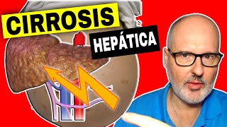 CIRROSIS HEPÁTICA 💥 Causas Síntomas y Tratamiento [upl. by Reeva]