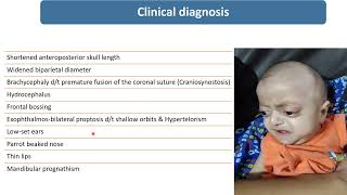 Crouzon’s Syndrome  Spot Diagnosis  4  Pediatrics [upl. by Rehnberg940]