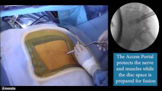 Minimally Invasive Lumbar Fusion amp Facet Fixation Surgery [upl. by Ratcliffe784]