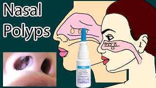 Nasal Polyps symptoms causes and treatment [upl. by Inigo925]