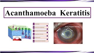 Acanthamoeba Keratitis [upl. by Zohar]