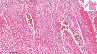 Myocardial Infarction  Histopathology [upl. by Etterraj]