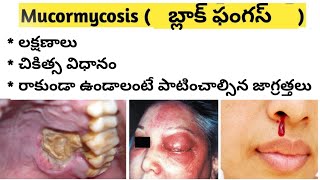 Black Fungal Infection in Covid  MucormycosisZygomycosis in Telugu [upl. by Hearsh]