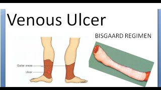 Surgery 137 Venous ulcer Bisgaard regimen method treatment [upl. by Cohby]