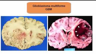 Glioblastoma Multiforme what you need to know [upl. by Airyk]