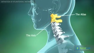 Atlantoaxial instability Definition [upl. by Eelyrag480]