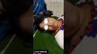 Permanently Remove Flat Moles  Mole Removal Near Eye  Laser Mole Removal Treatment shorts [upl. by Crooks245]