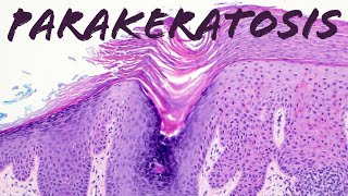 What is Parakeratosis amp Why does it happen Actinic keratosis vs Lichen simplex chronicus [upl. by Carry]