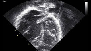 NEONATAL EBSTEINS ANOMALY [upl. by Friederike]