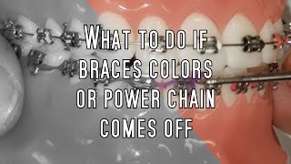 What to do if braces colors or power chain comes off [upl. by Ttelracs]