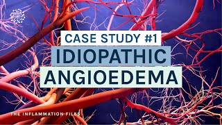 Idiopathic Angioedema  Case Study 1 The Inflammation Files with Dr Kara Wada [upl. by Malkah]