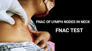 FNAC Test for Lymph Nodes in Neck।। [upl. by Asset933]