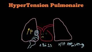 SmartNEasy Cardio  HyperTension Pulmonaire  Dr Astuce [upl. by Kanal918]