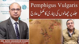 What is Pemphigus Vulgaris  Skin disease  Happy Patient  Prof Dr Azim  Cosmetique [upl. by Akemad690]