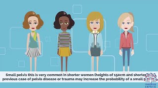 CEPHALOPELVIC DISPROPORTION CPD Causes Signs and Symptoms Diagnosis and Treatment [upl. by Kauffmann]