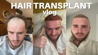 I GOT A HAIR TRANSPLANT IN TURKEY  VLOG [upl. by Venola639]