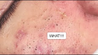 LOTS OF BLACKHEADS ON THE FACE 😨 GREAT JOB GA SPA PART II relaxing blackheads [upl. by Eyllib]