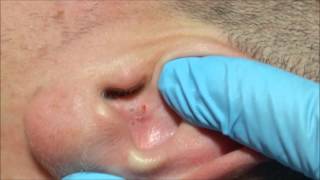 Ángels Acne Treatment Blackheads on the Ear [upl. by Freudberg]