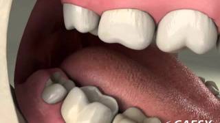 Oral Conditions Periconronitis [upl. by O'Doneven]