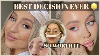 NOSE JOB VLOG My entire Rhinoplasty recovery  results the BEST Sydney surgeon [upl. by Fredella668]