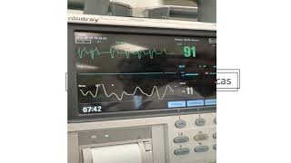 Cardioversión con Adenosina Taquicardia Paroxística Supraventricular y Técnica 2020 [upl. by Yeslek]