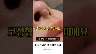 병원 가세요 코성형 부작용 이물육아종 코기둥 비주 낭종 병원 성형외과 rhinoplasty nose foreign body granuloma seoul korea아문TV [upl. by Efinnej234]