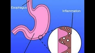 What is Gastritis [upl. by Finnie]