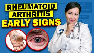 Early Warning Signs Of Rheumatoid Arthritis  Dont Ignore These Vital Symptoms [upl. by Merfe907]