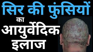 Ayurvedic Treatment for Scalp Folliculitis Causes amp Home Remedies [upl. by Garber748]