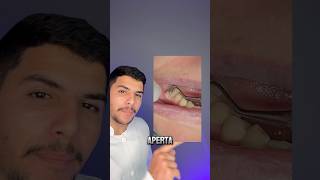 Abscesso dental ⚠️ Pode ser perigoso🤕 dentes curiosidades dentista odontologia [upl. by Korenblat530]