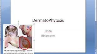 Microbiology 573 a DermatoPhytosis RingWorm Trichophyton Microsporum Epidermophyton ID reaction [upl. by Aivatahs]