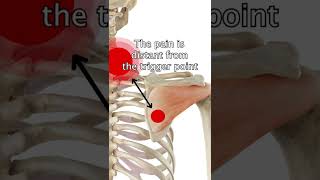 Infraspinatus Trigger Points [upl. by Thanasi596]