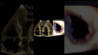 Tricuspid Valve Prolapse [upl. by Ellehsal]