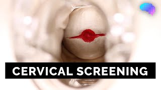 Cervical Screening SMEAR  OSCE Guide  UKMLA  CPSA [upl. by Naicul]