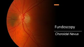 Choroidal Nevus Fundoscopy [upl. by Veriee]