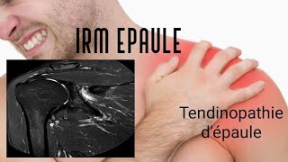 IRM DE L’EPAULE  tendinopathie [upl. by Aserej]