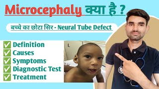 Microcephaly in Hindi  Causes Symptoms And Treatment of Microcephaly [upl. by Airalav769]