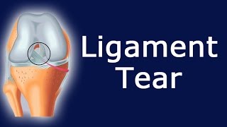 Ligament Tear [upl. by Lagas933]