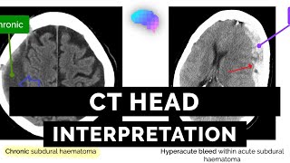 CT Head Interpretation for Beginners  OSCE Guide  UKMLA  CPSA [upl. by Georg]