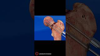 Orthopedic Hip Procedure Animation  shortsvideo [upl. by Kantor]