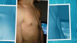 pectus carinatum brace  DIY [upl. by Ahsimet]