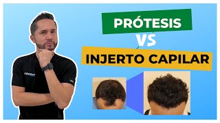 😵¿Qué es mejor Prótesis Capilar o Injerto de Cabello 🤔🤔 [upl. by Mellitz]