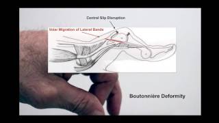 What is a Boutonnière Deformity [upl. by Khalin]