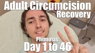 Adult Circumcision Recovery Experience  Day 1 to 46 Phimosis 21yo [upl. by Bernadina]