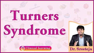 20 Turners Syndrome [upl. by Ailet]